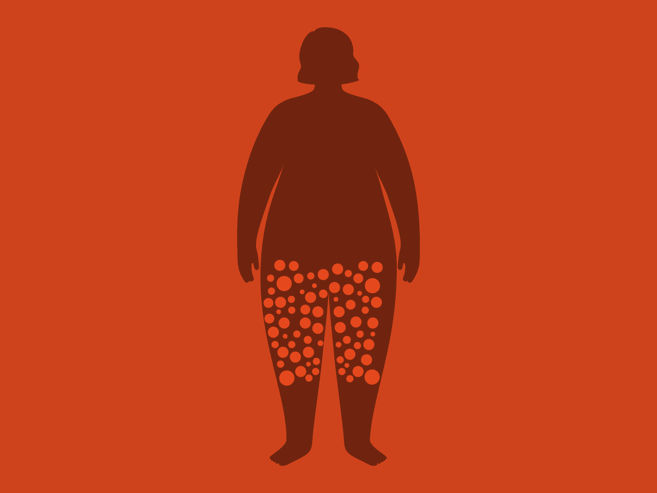 LIPEDEMA
