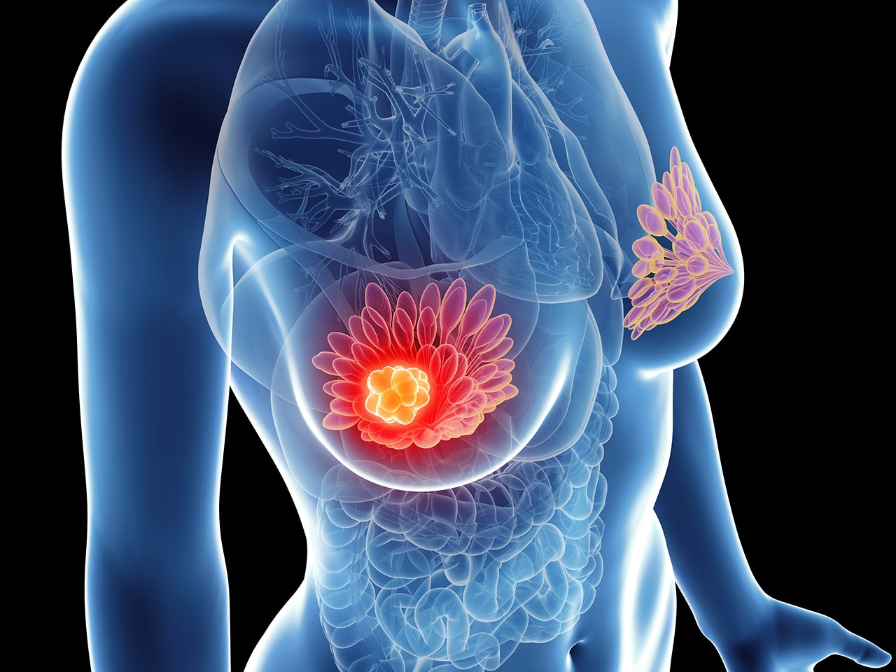 BREAST CANCER