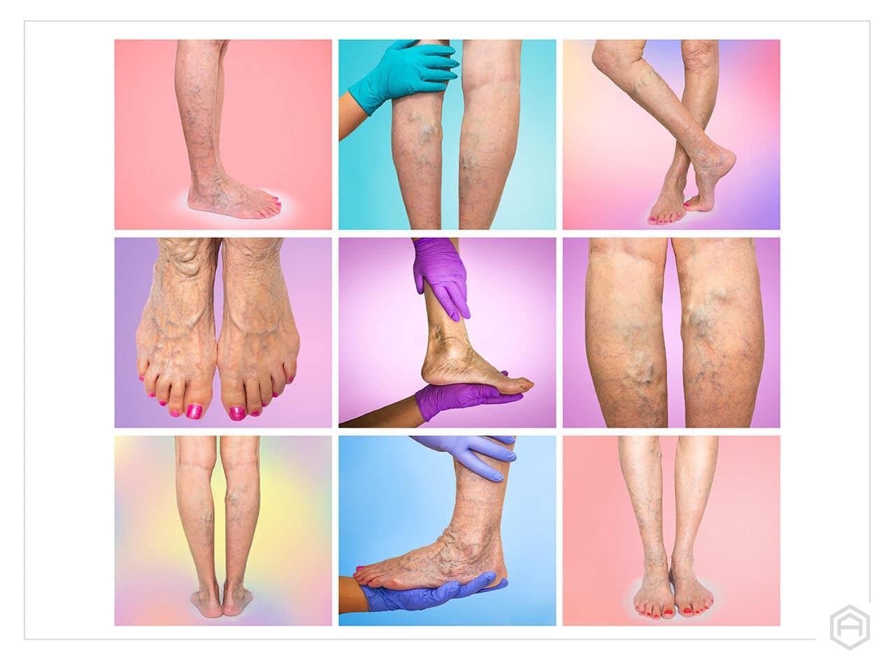 Chronic Venous Insufficiency