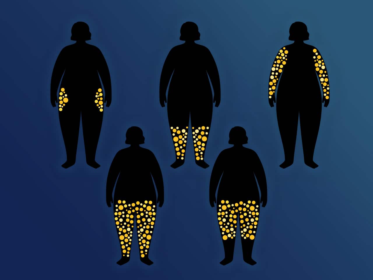 LIPEDEMA