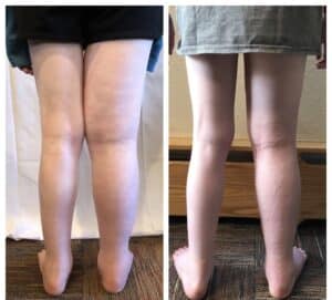 Patient Before and After from using the AIROS 6 device