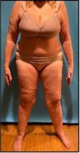 Lipedema Patient