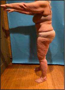 Lipedema Patient